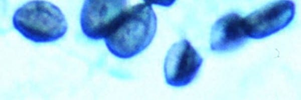 [Physician Comment] Pneumocystis linked to Sudden Unexpected Infant Deaths