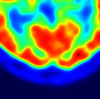 Artificial neural networks predict survival in brain metastasis patients