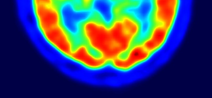 Childhood ADHD associated with increased risk of suicide [Physician Comment]