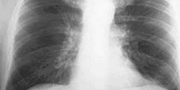 Pneumonia_x-ray (1)