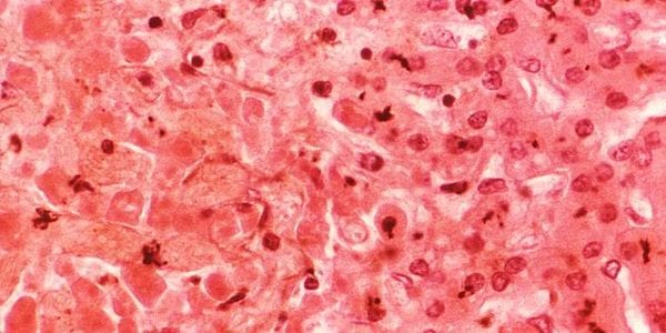 Signs of hepatitis c in adults