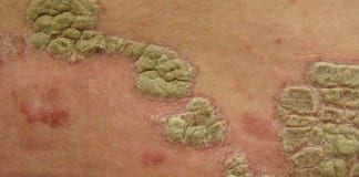Patients with psoriasis at an increased risk of avascular Patients with psoriasis at an increased risk of avascular