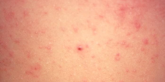 Measles - Symptoms - NHS Choices