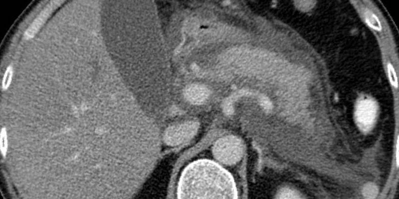 pancreatitis