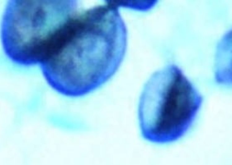 [Physician Comment] Pneumocystis linked to Sudden Unexpected Infant Deaths