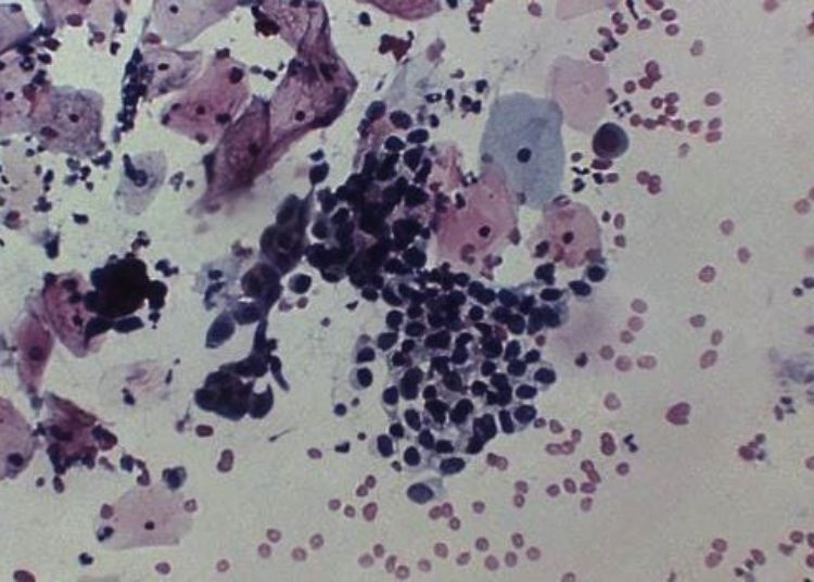 Updated Pap smear screening guidelines may delay diagnosis of cervical adenocarcinoma in situ