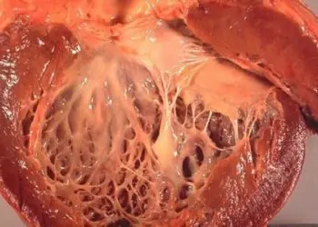 Fibrosis linked with mortality in nonischemic dilated cardiomyopathy patients