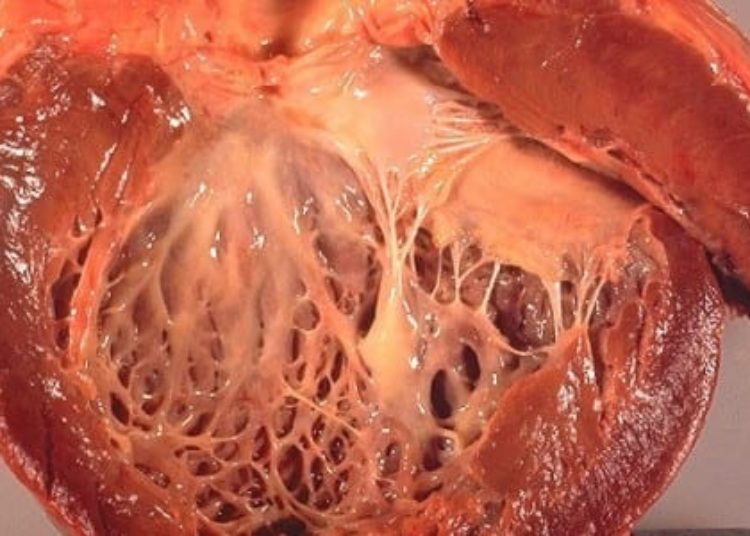 Fibrosis linked with mortality in nonischemic dilated cardiomyopathy patients