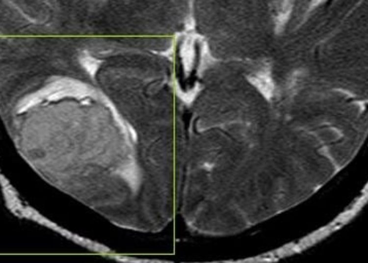 Patients at long-term increased mortality risk following stroke at young age