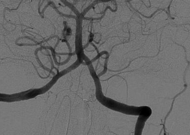Low infection risk with neurologic endovascular procedures