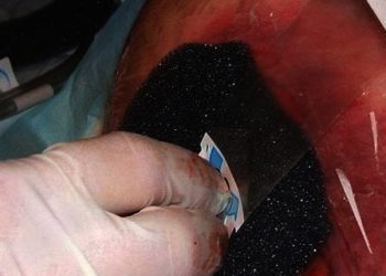 Negative pressure wound therapy for open abdomens appears safe