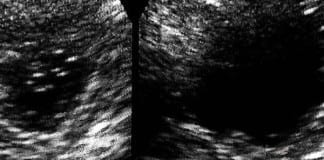 Reminder intervention increases colorectal cancer screening rates