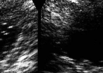 Reminder intervention increases colorectal cancer screening rates