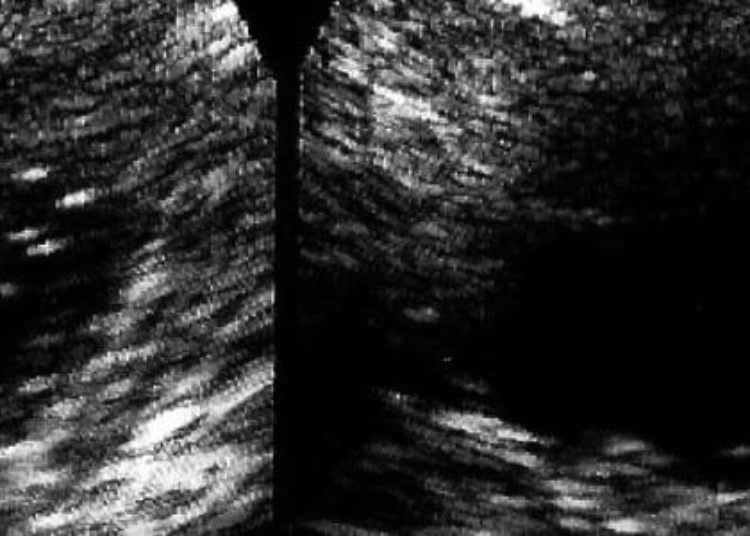 Reminder intervention increases colorectal cancer screening rates
