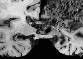 Radiosurgery safe and effective for unruptured intracranial AVMs