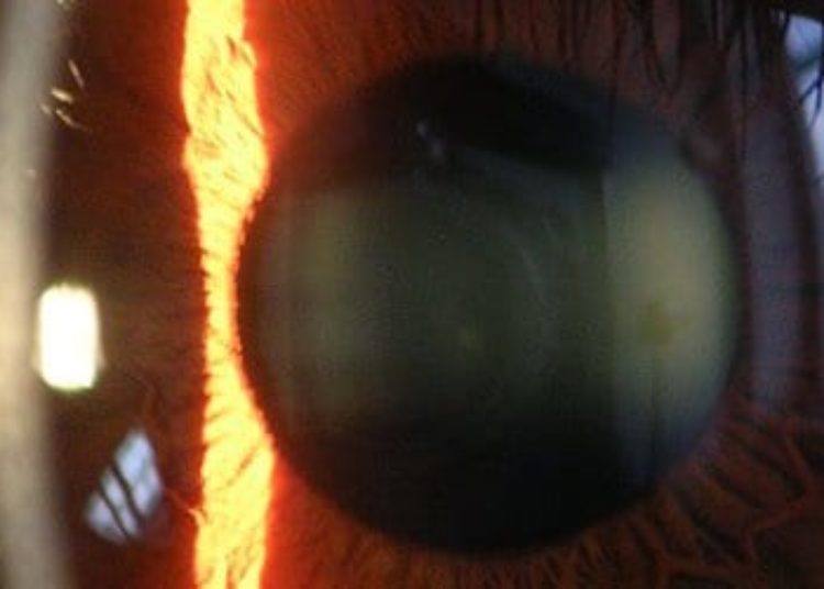 Artifical cornea is well-retained in patients with ocular surface disease