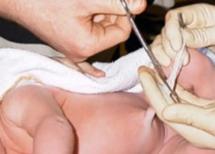 Chlorhexidine cleansing linked to prolonged umbilical stump separation