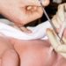 Chlorhexidine cleansing linked to prolonged umbilical stump separation