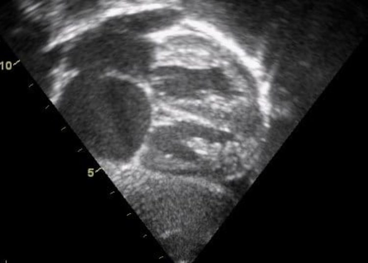 PFO closure equivalent to medical management in prevention of recurrent stroke [PC and RESPECT trials]