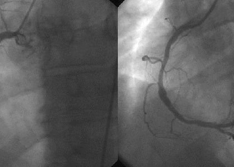Nonemergent percutaneous coronary intervention safe without on-site cardiac surgery services