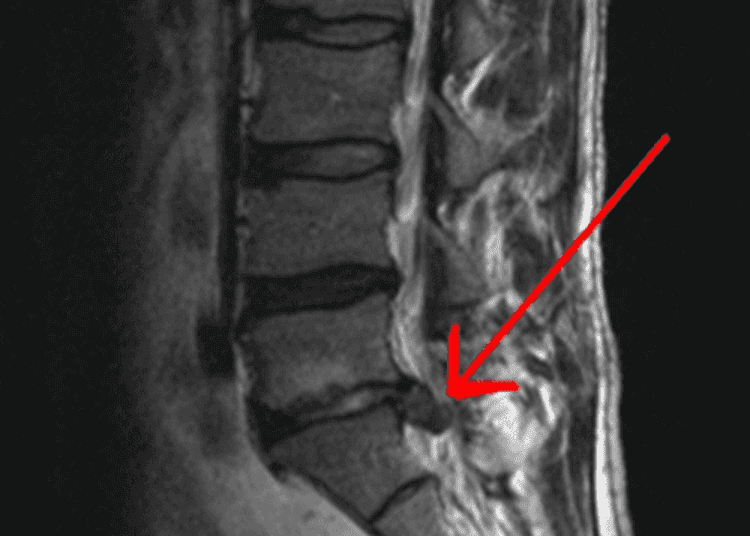 MRI evidence of disc herniation is not predictive of clinical outcome in sciatica