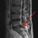 MRI evidence of disc herniation is not predictive of clinical outcome in sciatica