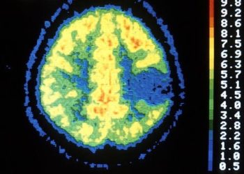 Lacosamide may be safe and effective supplemental anti-epileptic drug