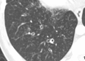 Azithromycin lowers rate of infectious exacerbations in bronchiectasis patients