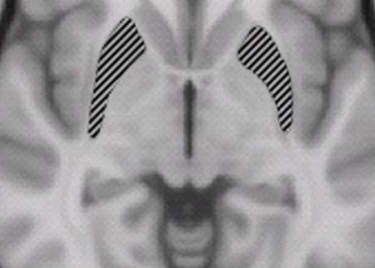 Deep Brain Stimulation appears safe and may be effective for refractory anorexia nervosa [Physician Comment]