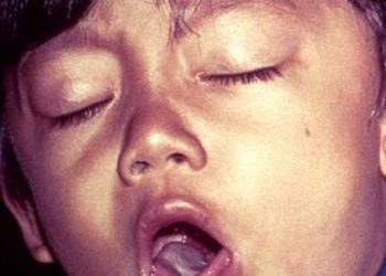 Algorithm improves pediatric chronic cough outcomes