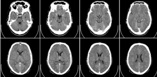 Earlier thrombolysis associated with improved stroke outcomes