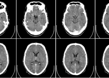 CTA as an alternative to angiography for blunt cerebrovascular trauma detection