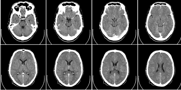 Computed_tomography_of_human_brain_-_large