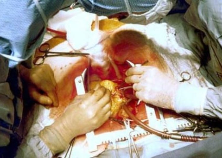 Coronary bypass survival benefits shine in high-risk patients