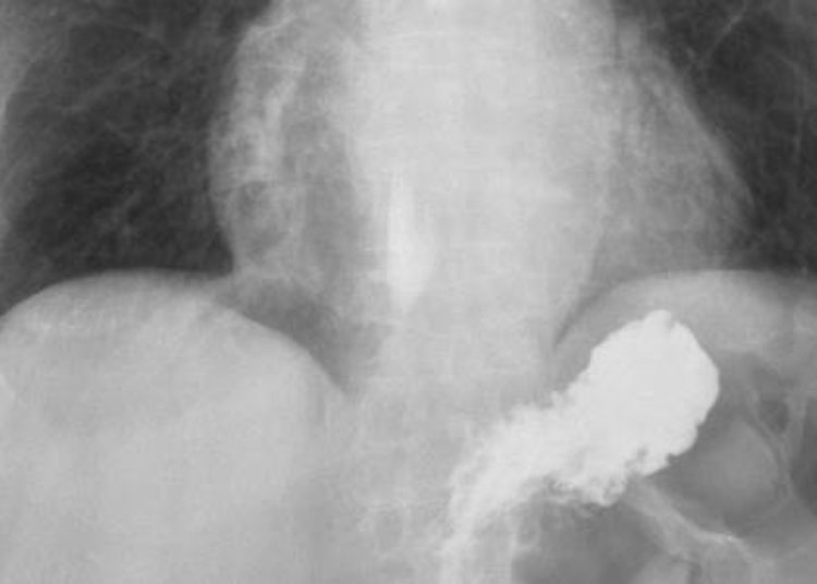 New pediatric GERD management guidelines released