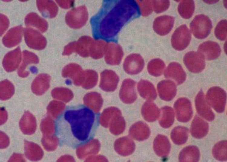 Antibiotic rash in children with mononucleosis much lower than previously reported