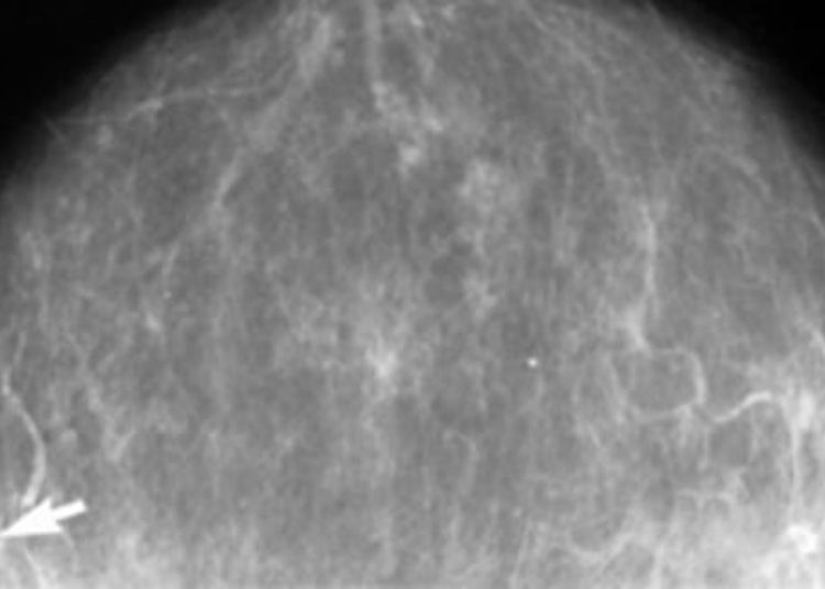 USPSTF recommends chemoprevention for women at high risk for breast cancer