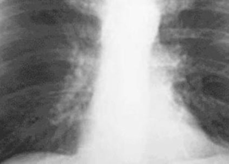 X-ray after foreign body removal by esophagoscopy is not cost effective