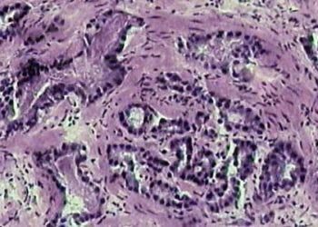 Androgen deprivation in prostate cancer: intermittent may compromise survival