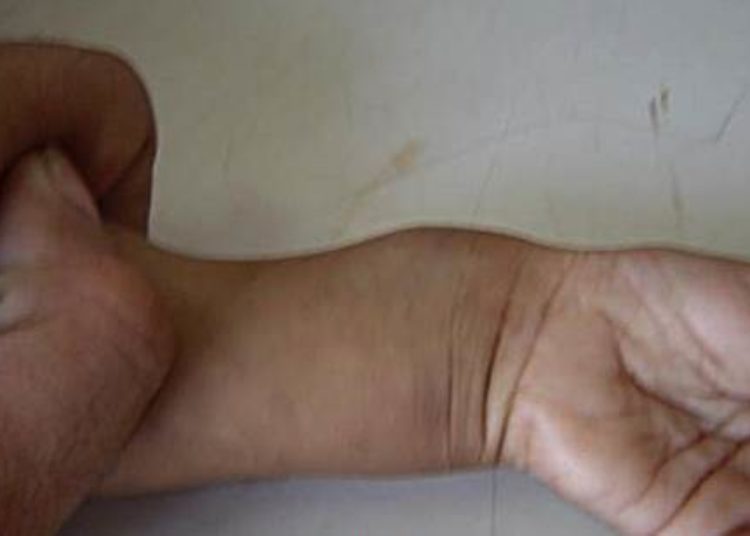 Do higher doses help? Infant bone health similar despite varying Vitamin D doses