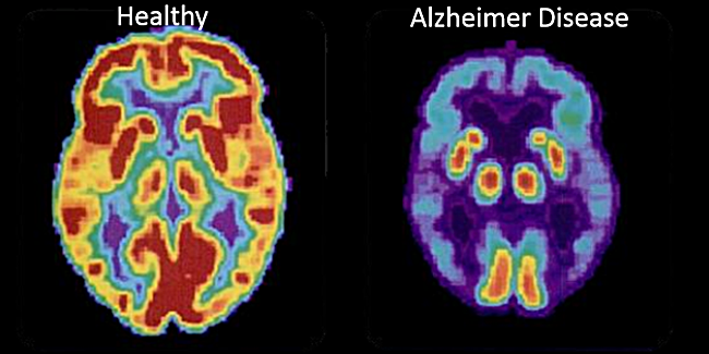 Brain PET scan