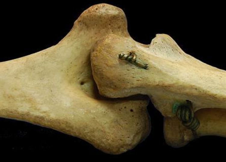 Novel combination therapy improves bone mineral density in postmenopausal osteoporosis