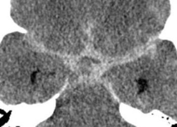 Subarachnoid hemorrhage patients receive significant radiation exposure