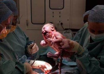 Obtaining consent for c-section during labor may be suboptimal