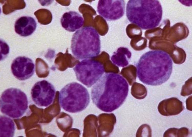 New leukemia mutation offers therapeutic targets