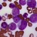 New leukemia mutation offers therapeutic targets