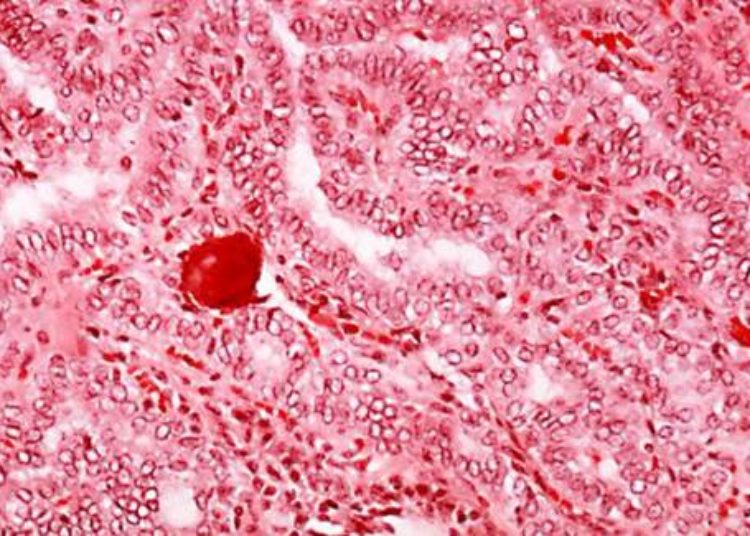 No long-term follow-up for benign thyroid nodules