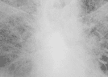 Prone positioning decreases mortality in severe ARDS (PROSEVA Trial)