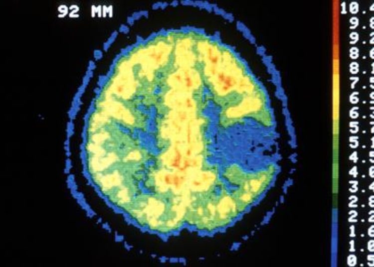 CT scans linked to cancer risk in children