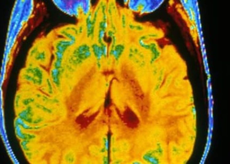 Pre-operative transcranial magnetic stimulation useful for language mapping